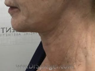 Neck Lift Before & After Gallery - Patient 126132 - Image 2