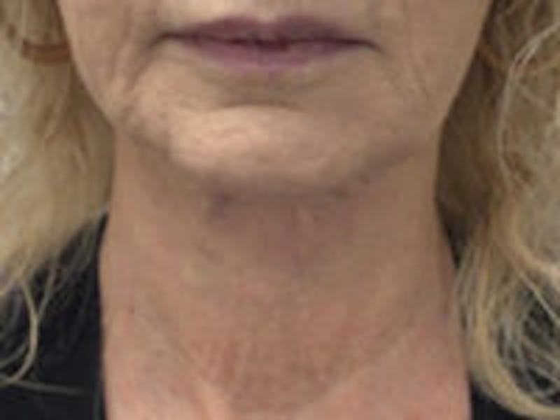 Neck Lift Before & After Gallery - Patient 126132 - Image 3