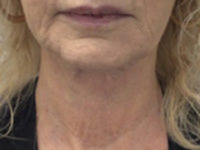 Neck Lift Before & After Gallery - Patient 126132 - Image 3