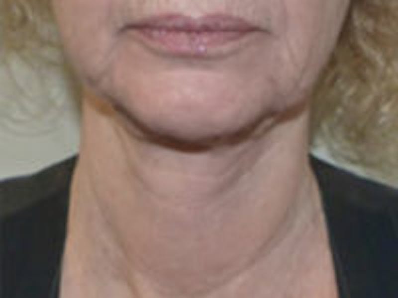Neck Lift Before & After Gallery - Patient 126132 - Image 4
