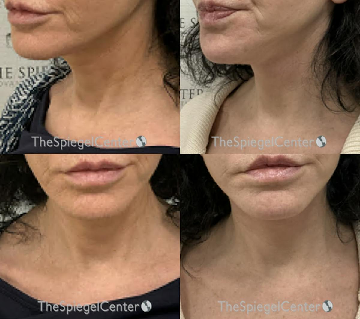 Neck Lift Before & After Gallery - Patient 862785 - Image 1