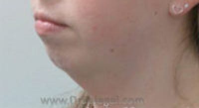 Neck Lift Before & After Gallery - Patient 766241 - Image 1