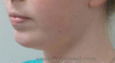 Neck Lift Before & After Gallery - Patient 766241 - Image 2