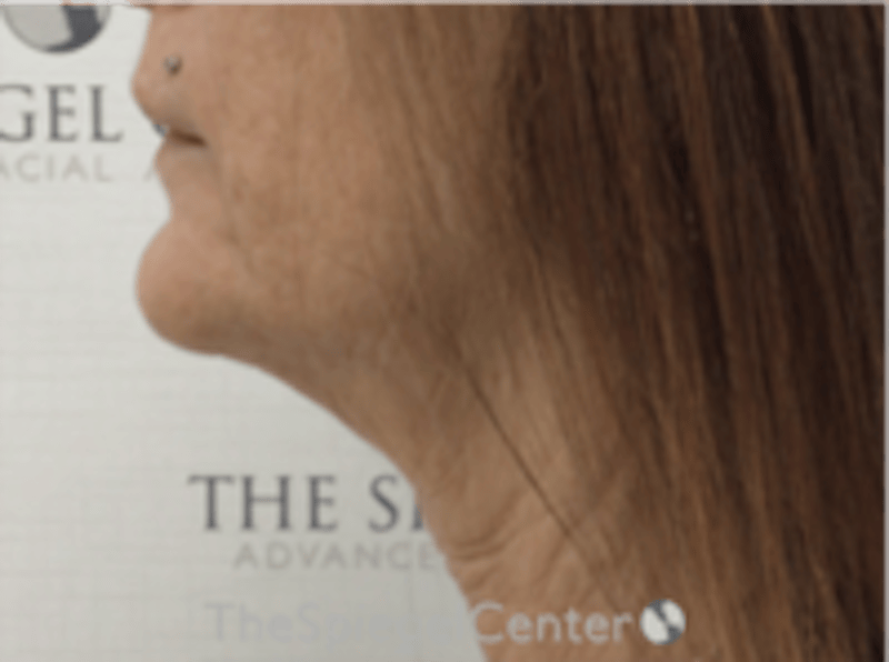 Neck Lift Before & After Gallery - Patient 835420 - Image 1
