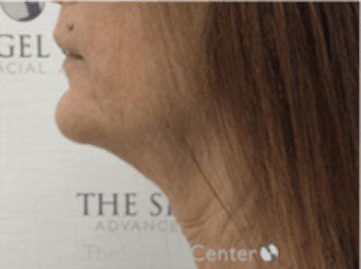 Neck Lift Before & After Gallery - Patient 835420 - Image 1