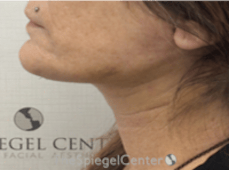 Neck Lift Before & After Gallery - Patient 835420 - Image 2