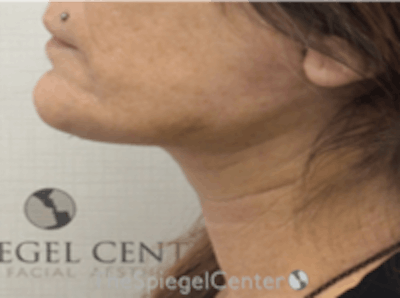 Neck Lift Before & After Gallery - Patient 835420 - Image 2