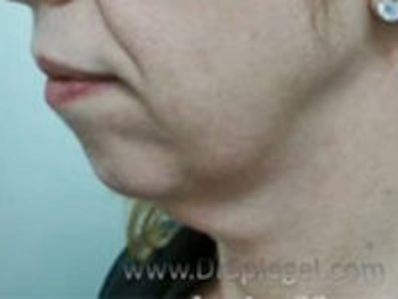 Neck Lift Before & After Gallery - Patient 220129 - Image 1