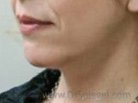 Neck Lift Before & After Gallery - Patient 220129 - Image 2