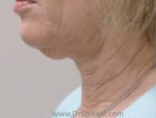 Neck Lift Before & After Gallery - Patient 356397 - Image 1