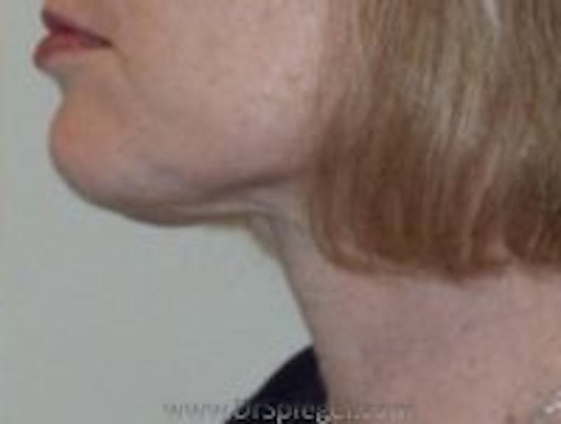 Neck Lift Before & After Gallery - Patient 356397 - Image 2