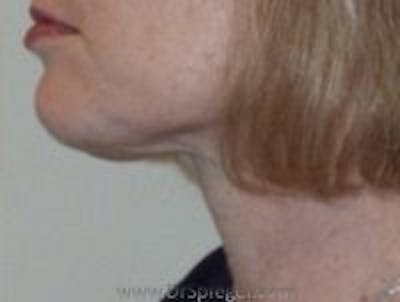Neck Lift Before & After Gallery - Patient 356397 - Image 2