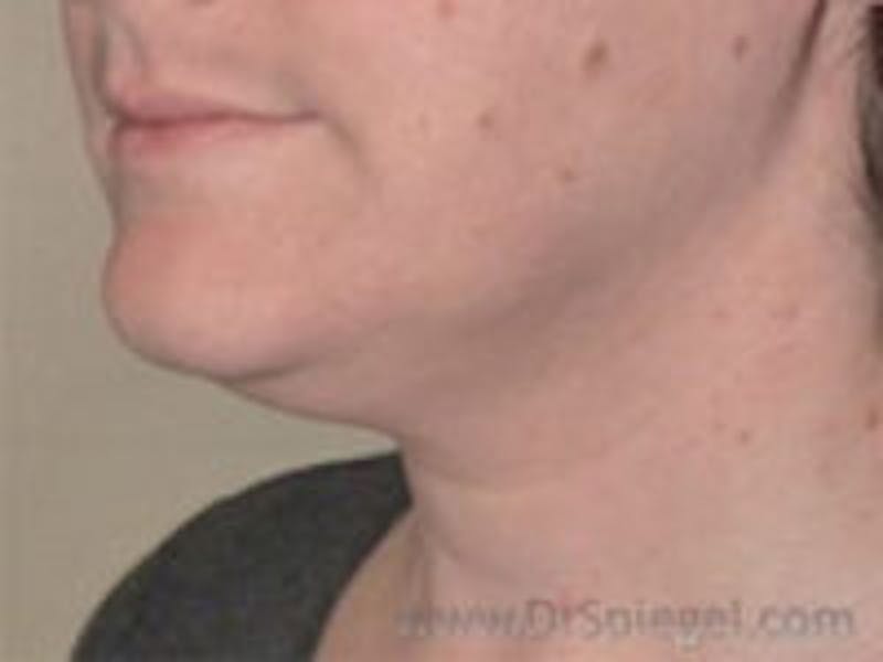 Neck Lift Before & After Gallery - Patient 307467 - Image 1