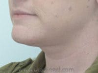 Neck Lift Before & After Gallery - Patient 307467 - Image 2