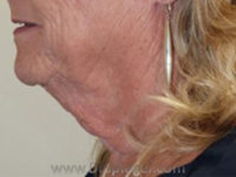 Neck Lift Before & After Gallery - Patient 188730 - Image 1