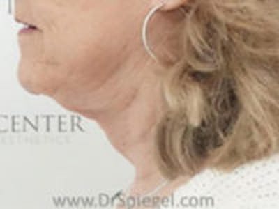 Neck Lift Before & After Gallery - Patient 188730 - Image 2