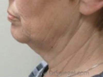 Neck Lift Before & After Gallery - Patient 234936 - Image 1