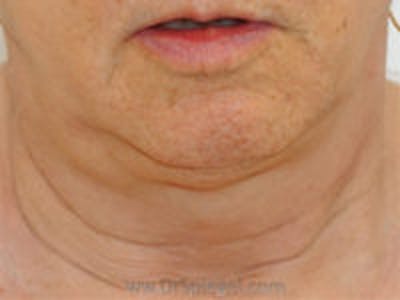 Neck Lift Before & After Gallery - Patient 316404 - Image 1