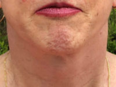 Neck Lift Before & After Gallery - Patient 316404 - Image 2