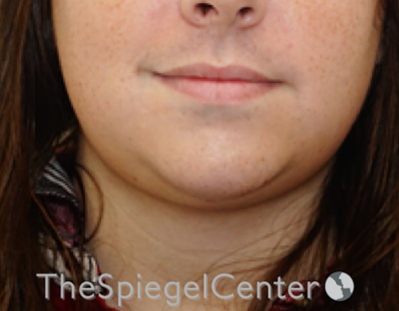 Neck Lipo Before & After Gallery - Patient 218155 - Image 1