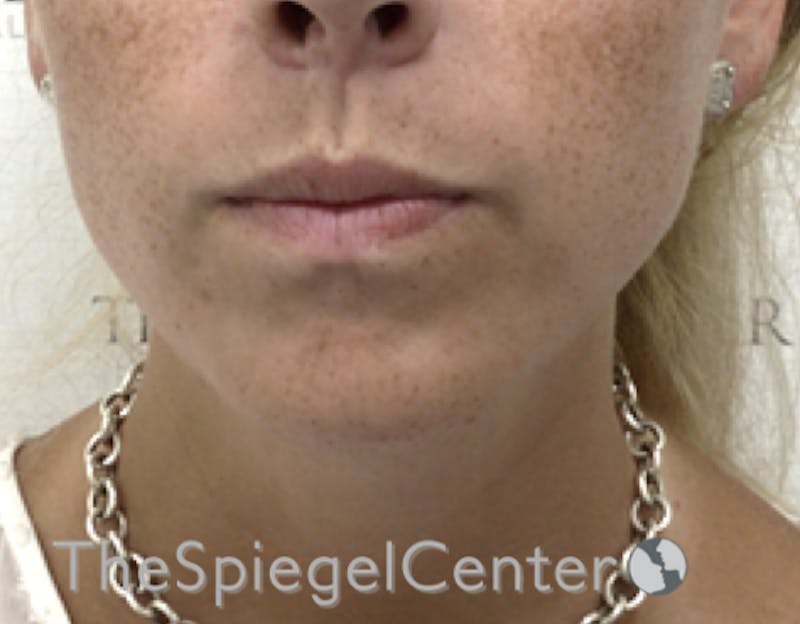 Neck Lipo Before & After Gallery - Patient 218155 - Image 2