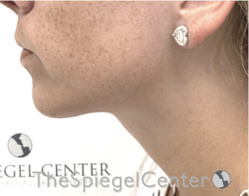 Neck Lipo Before & After Gallery - Patient 218155 - Image 4