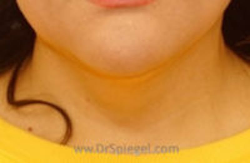 Neck Lipo Before & After Gallery - Patient 379454 - Image 2