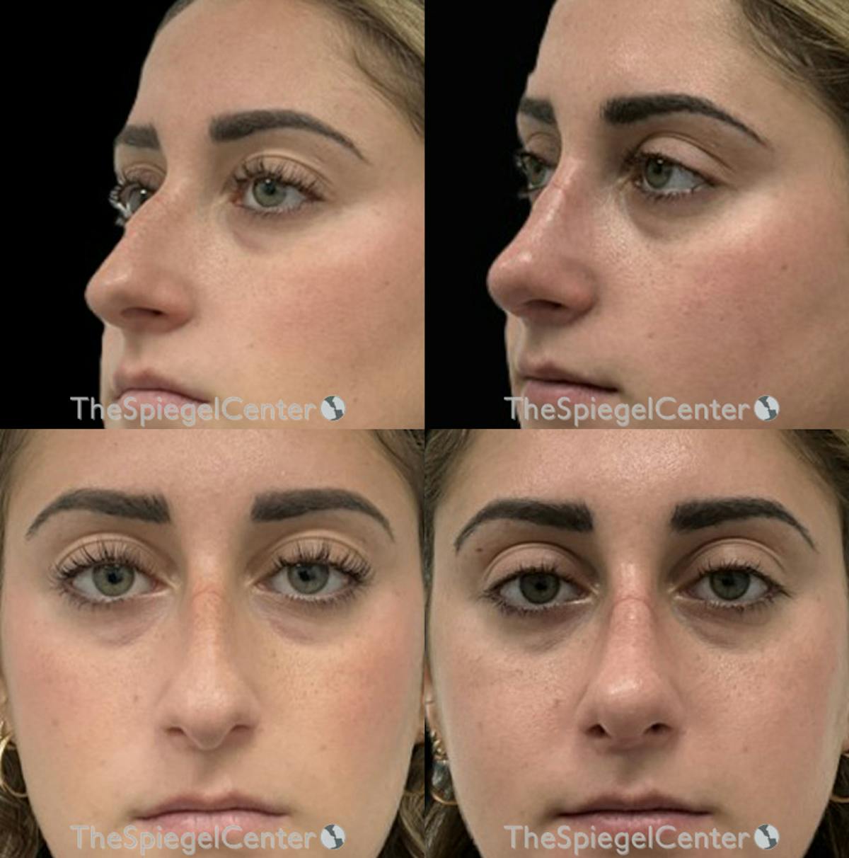 Rhinoplasty Before & After Gallery - Patient 302345 - Image 1