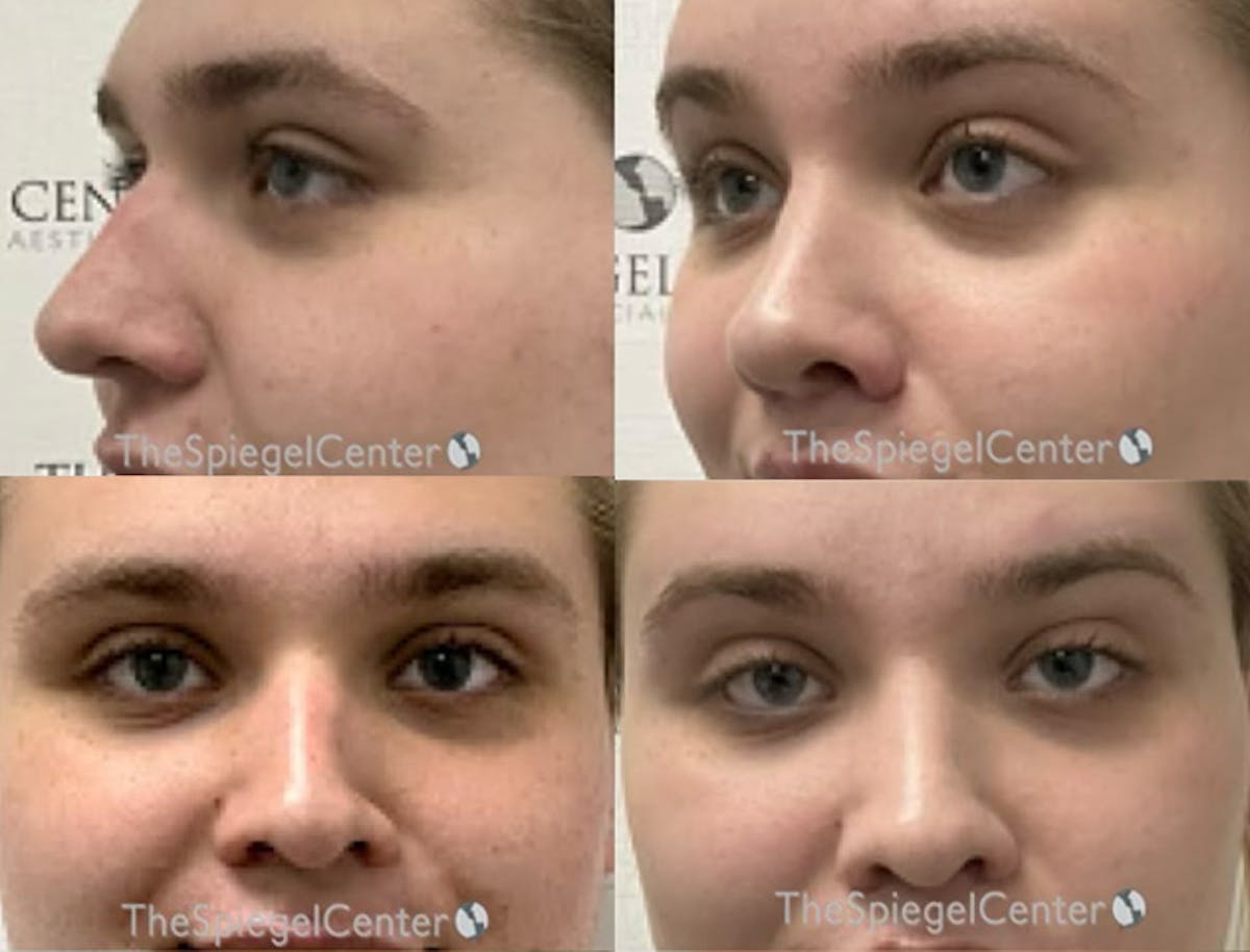 Rhinoplasty Before & After Gallery - Patient 344579 - Image 1