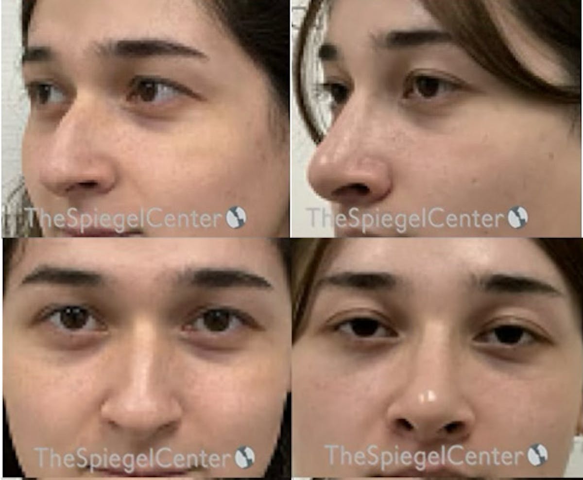 Rhinoplasty Before & After Gallery - Patient 198311 - Image 1