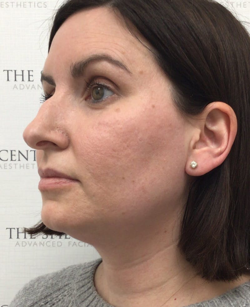 Rhinoplasty Before & After Gallery - Patient 997033 - Image 1