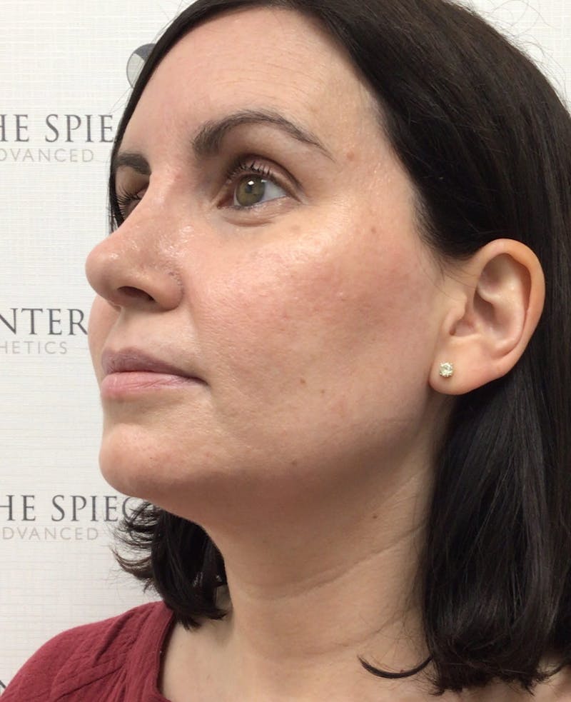 Rhinoplasty Before & After Gallery - Patient 997033 - Image 2