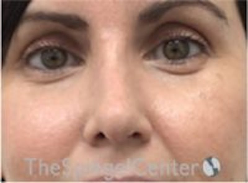 Rhinoplasty Before & After Gallery - Patient 997033 - Image 3