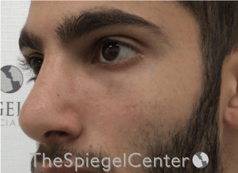 Rhinoplasty Before & After Gallery - Patient 228833 - Image 2