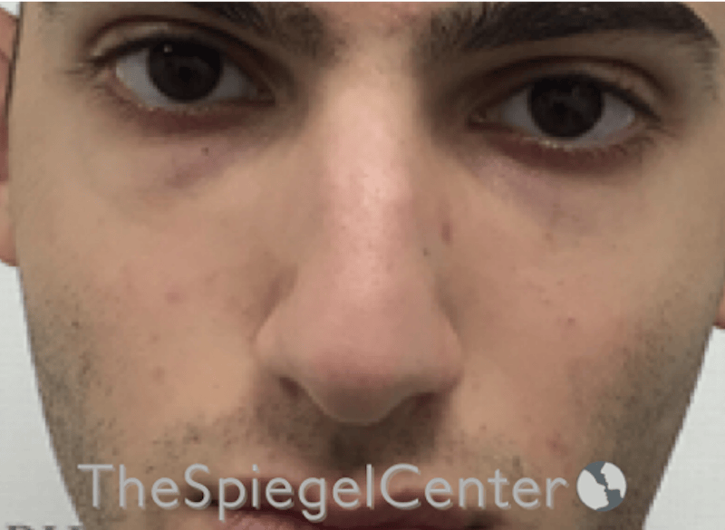 Rhinoplasty Before & After Gallery - Patient 228833 - Image 3