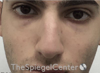 Rhinoplasty Before & After Gallery - Patient 228833 - Image 3