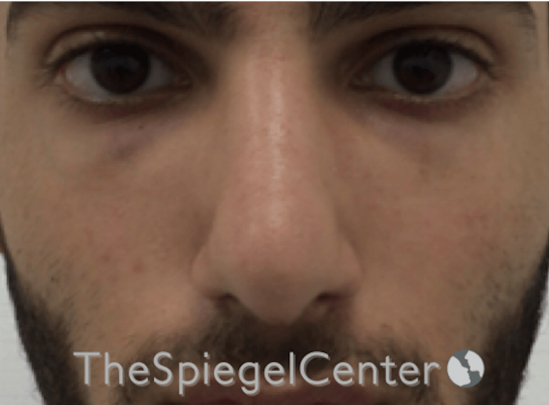 Rhinoplasty Before & After Gallery - Patient 228833 - Image 4