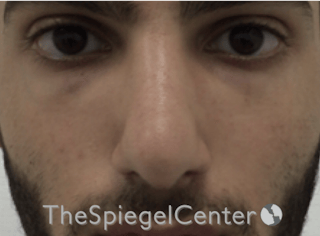 Rhinoplasty Before & After Gallery - Patient 228833 - Image 4