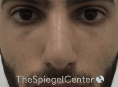 Rhinoplasty Before & After Gallery - Patient 228833 - Image 4