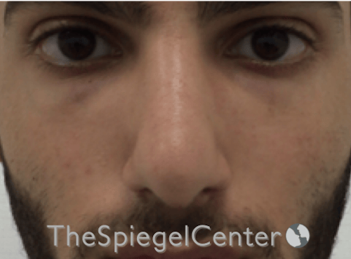 Rhinoplasty Before & After Gallery - Patient 228833 - Image 4