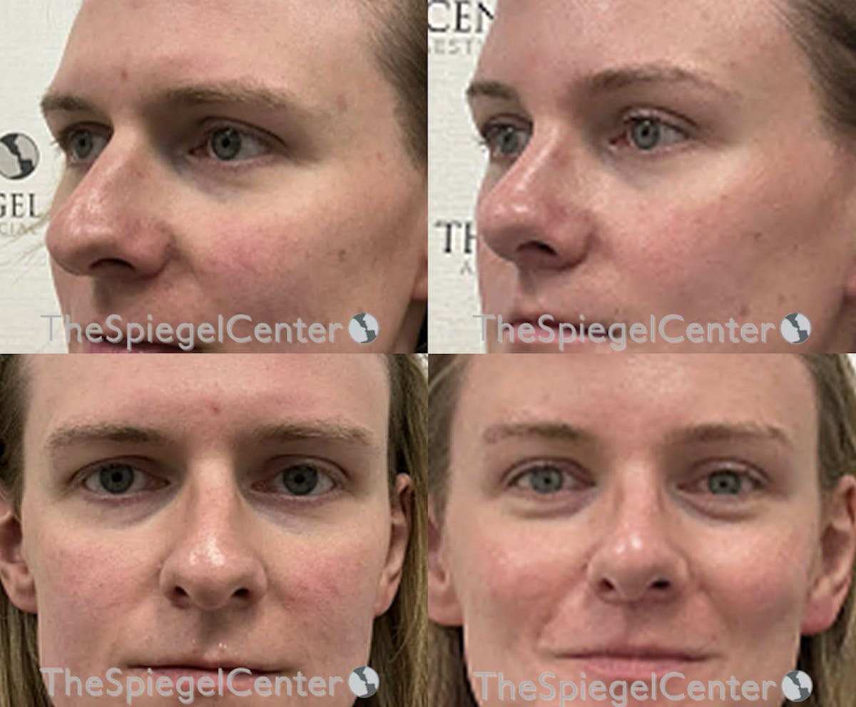 Rhinoplasty Before & After Gallery - Patient 163671 - Image 1