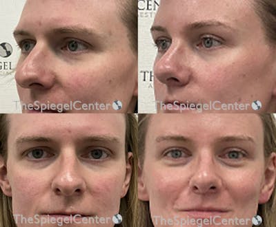 Rhinoplasty Before & After Gallery - Patient 163671 - Image 1