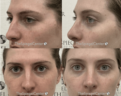 Rhinoplasty Before & After Gallery - Patient 290787 - Image 1