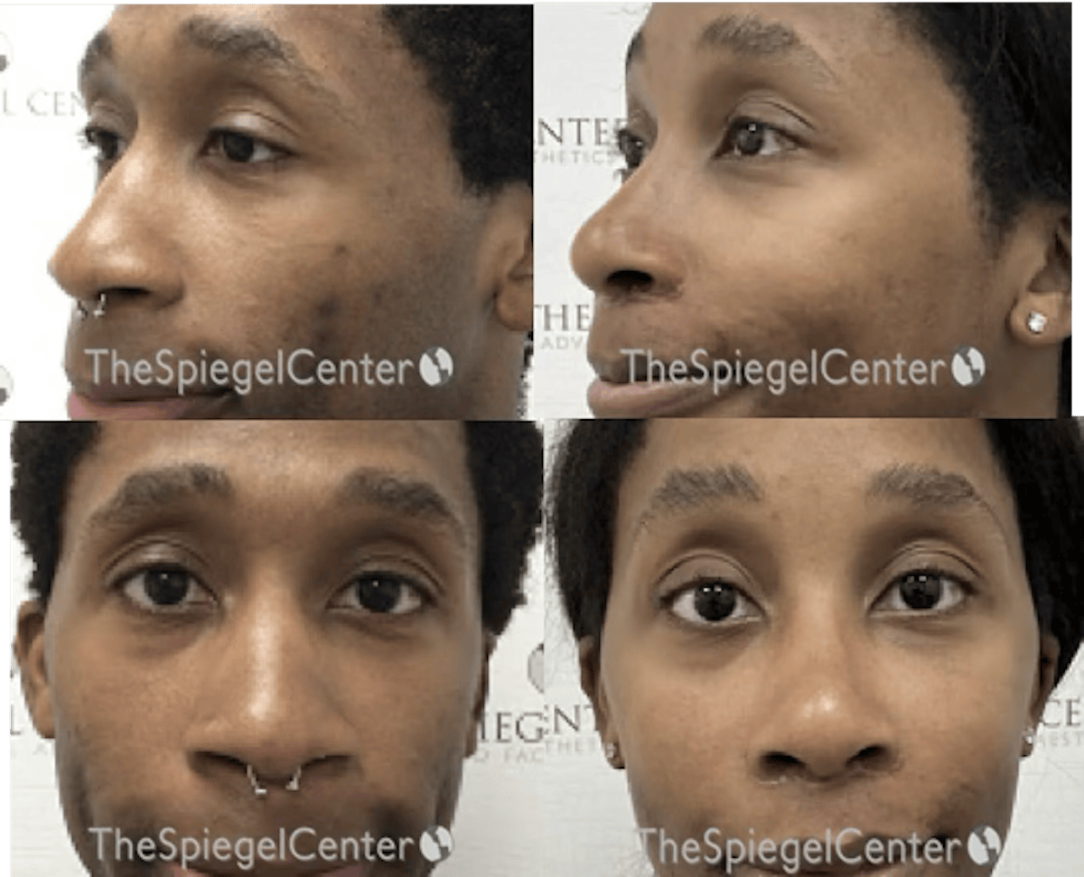 Rhinoplasty Before & After Gallery - Patient 778077 - Image 1