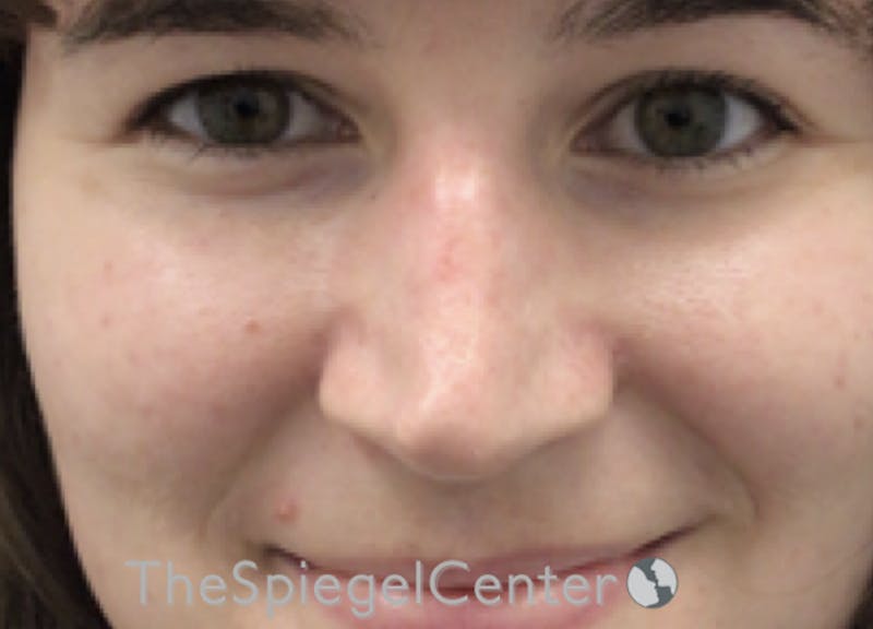 Rhinoplasty Before & After Gallery - Patient 294095 - Image 3