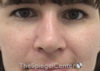 Rhinoplasty Before & After Gallery - Patient 294095 - Image 4