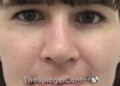 Rhinoplasty Before & After Gallery - Patient 294095 - Image 4