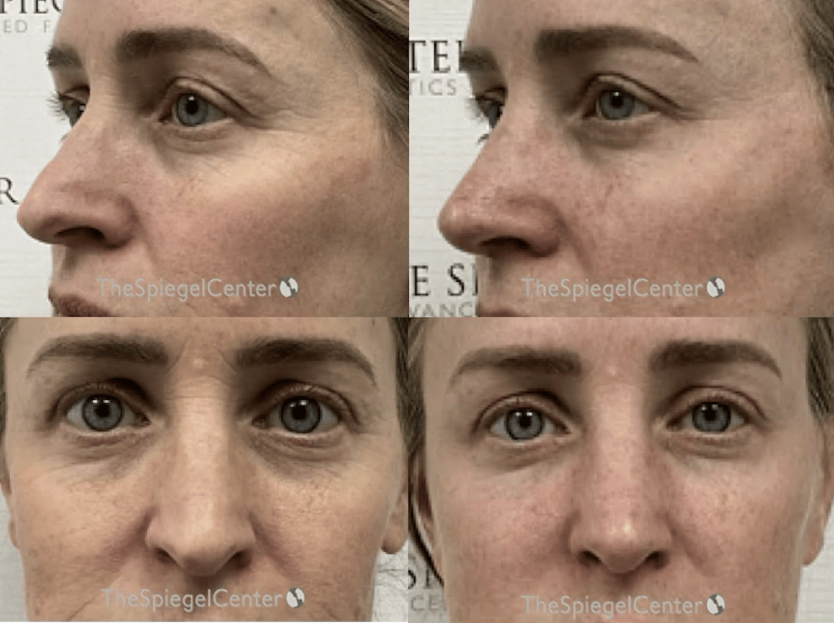 Rhinoplasty Before & After Gallery - Patient 398008 - Image 1