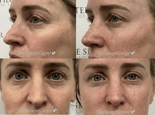 Rhinoplasty Before & After Gallery - Patient 398008 - Image 1