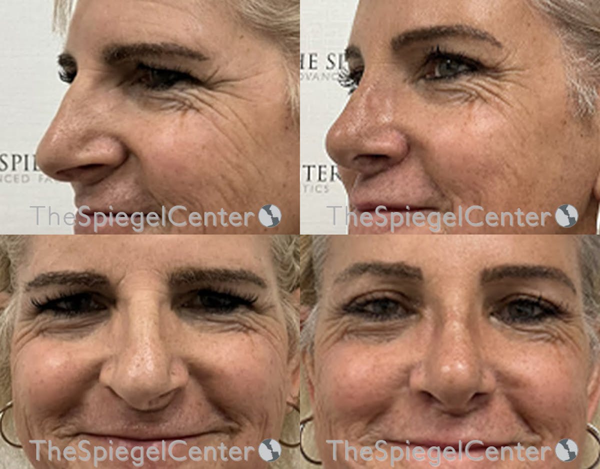 Rhinoplasty Before & After Gallery - Patient 115796 - Image 1